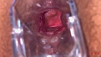 Anal Vision Speculum